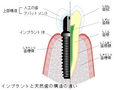 インプラントと天然歯の構造の違い