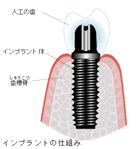 インプラントの仕組み