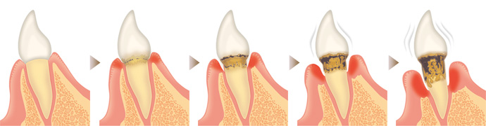 歯周病